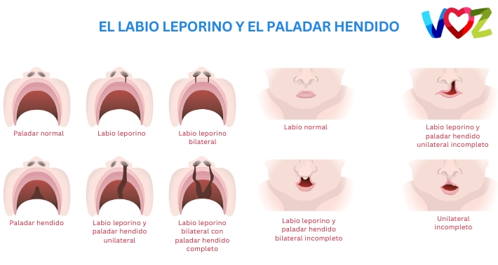 ¿Qué es el labio leporino y el paladar hendido? | El Instituto Voz | Clínica de Terapia del habla Bilingüe en Washington DC