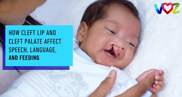 How Cleft Lip And Cleft Palate Affect Speech, Language, And Feeding | The Voz Institute | Pediatric Speech Therapist Clinic Washington DC