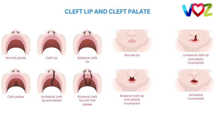 What Is Cleft Lip And Cleft Palate? | The Voz Institute | Pediatric Speech Therapist Clinic Washington DC